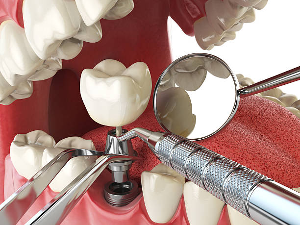 Best Emergency Denture Repair in Columbus, MT
